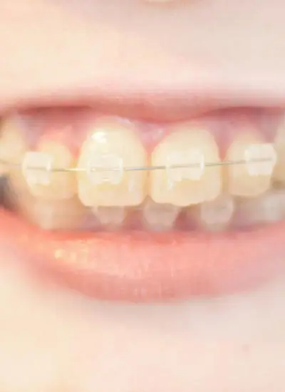 矯正装置の女性