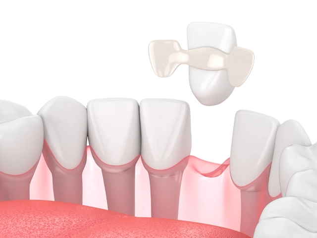 抜けてしまった前歯を補う接着性ブリッジ