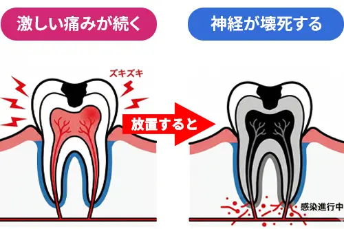 むし歯を放置して神経の感覚がなくなる解説図
