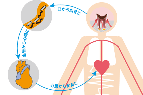 細菌が全身に回るメカニズム解説図