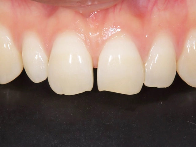 すきっ歯の前歯