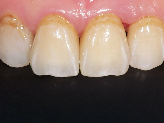 前歯ジルコニアクラウン治療後