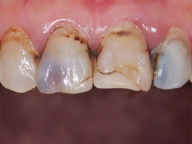 前歯ジルコニアクラウン治療前