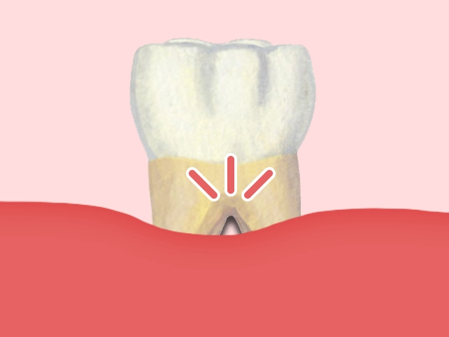 根分岐部病変になった歯のイメージ