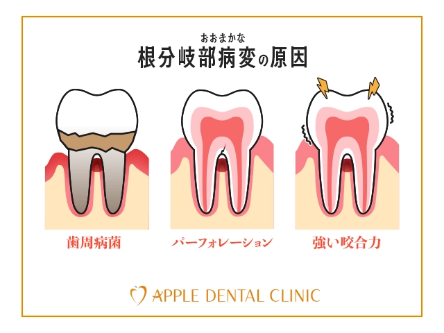 根分岐部病変の原因を説明したイラスト
