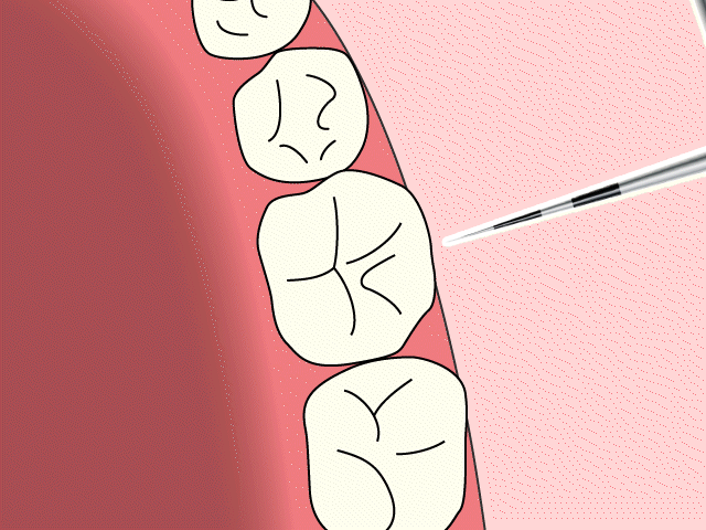根分岐部病変の確認のためにプローブを歯に通すアニメーション