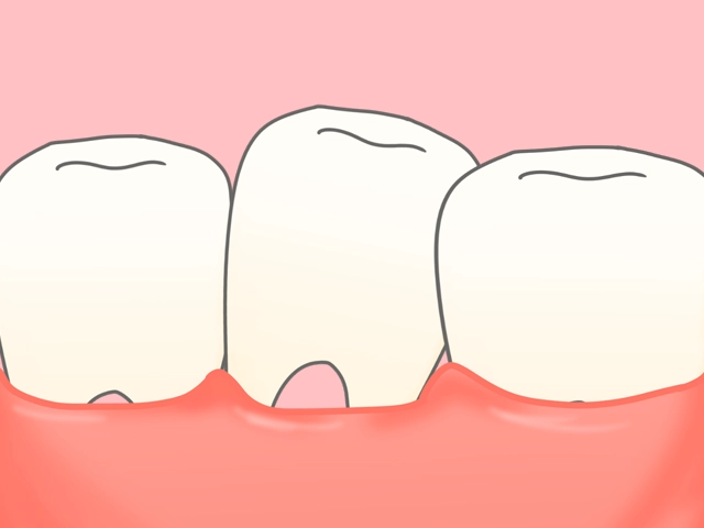 根分岐部病変が進み抜けそうになっている奥歯