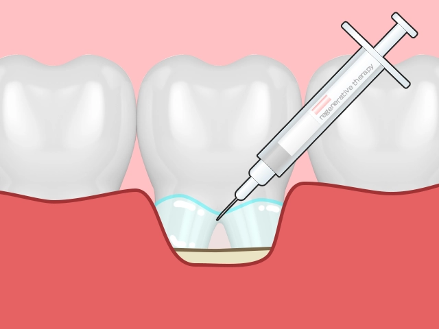 歯肉切開をして再生材料を注入する歯周組織再生治療