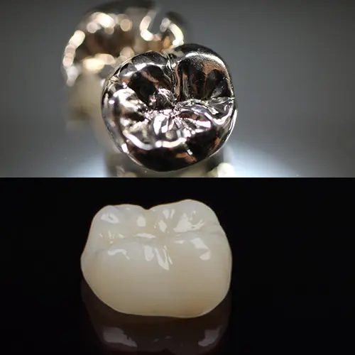 セラミックの白い歯と銀歯の比較