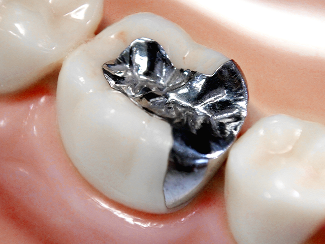 銀歯の詰め物と歯の隙間のイラスト