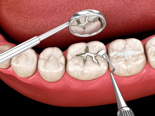 コンポジットレジンの詰め物