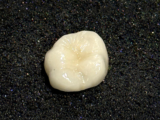 オールセラミックの被せ物