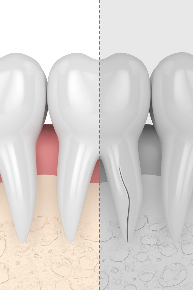 根っこが割れた歯のヘミセクションのイメージ