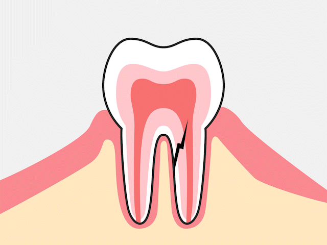 ヘミセクションの治療アニメーション