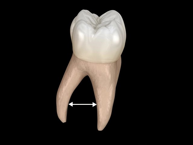 歯根と歯根の距離