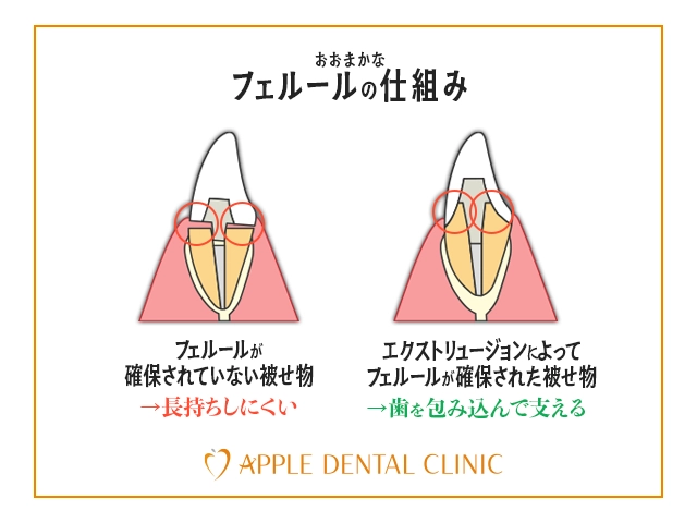 エクストリュージョンによって得られるフェルールの説明