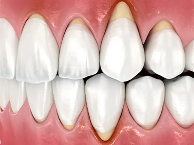 歯周ポケットと歯周病菌