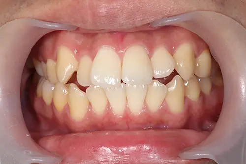 八重歯の治療前写真