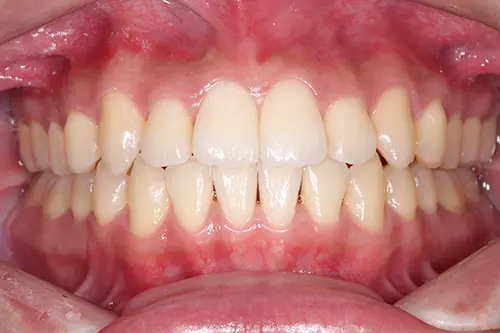 八重歯の治療後写真