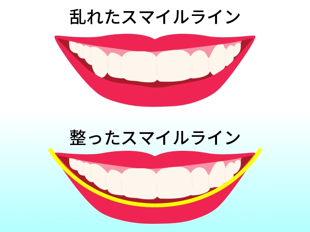 理想的なスマイルラインのイメージ